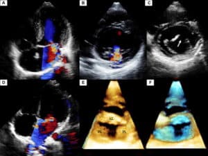 Insufici Ncia Mitral Aspectos Etiopatol Gicos Blog Ecope