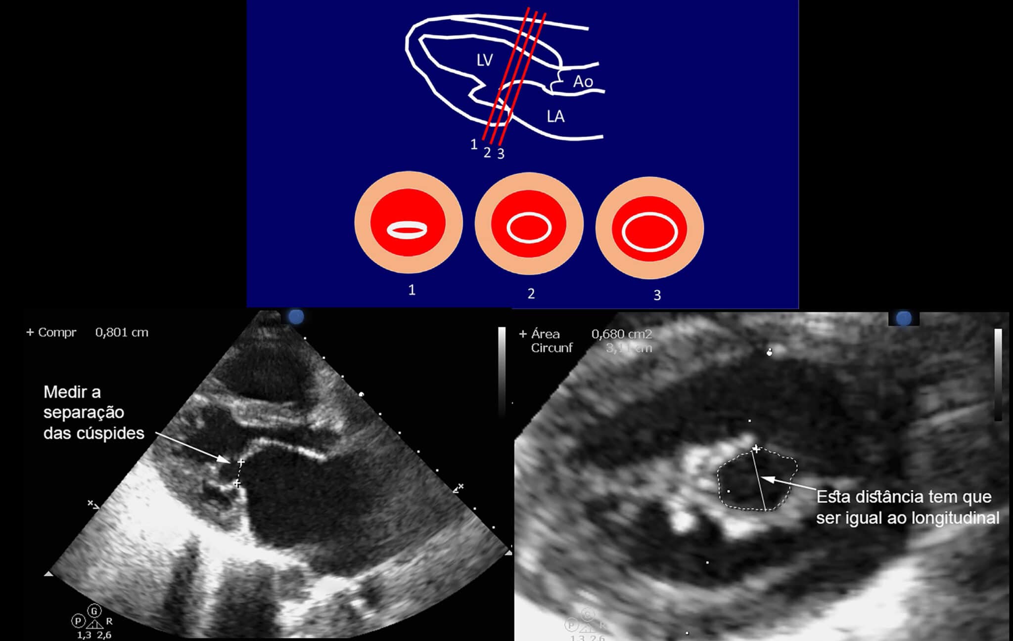 Interpretando O Guideline De Estenose Mitral Reum Tica Ase Blog