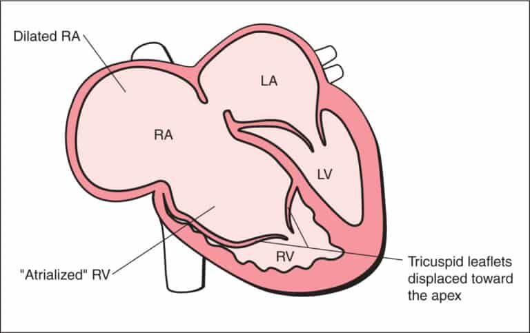 Anomalia de Ebstein aspectos ecocardiográficos Blog Ecope