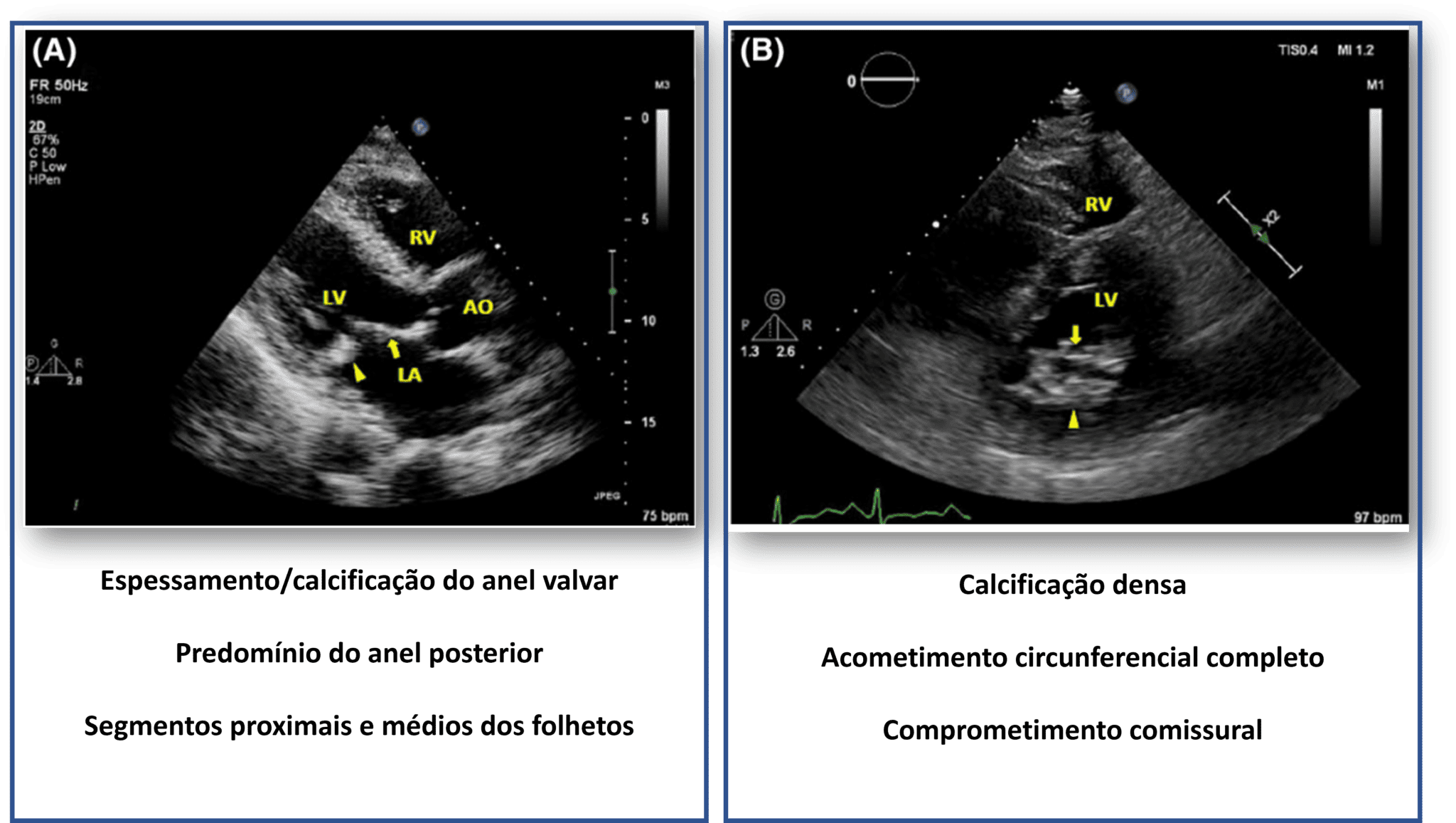 Estenose Mitral Degenerativa Revis O Blog Ecope