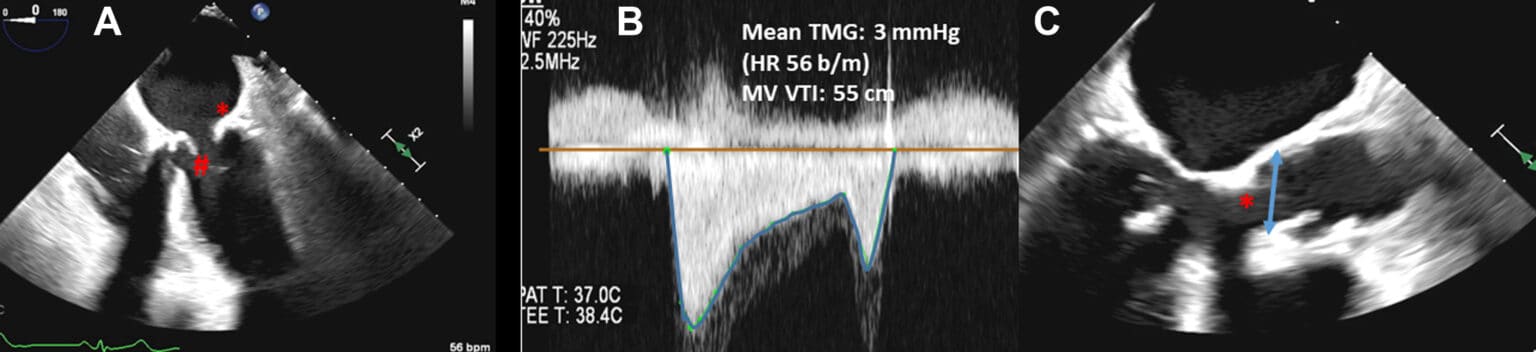 Estenose Mitral Degenerativa Casos Cl Nicos Blog Ecope