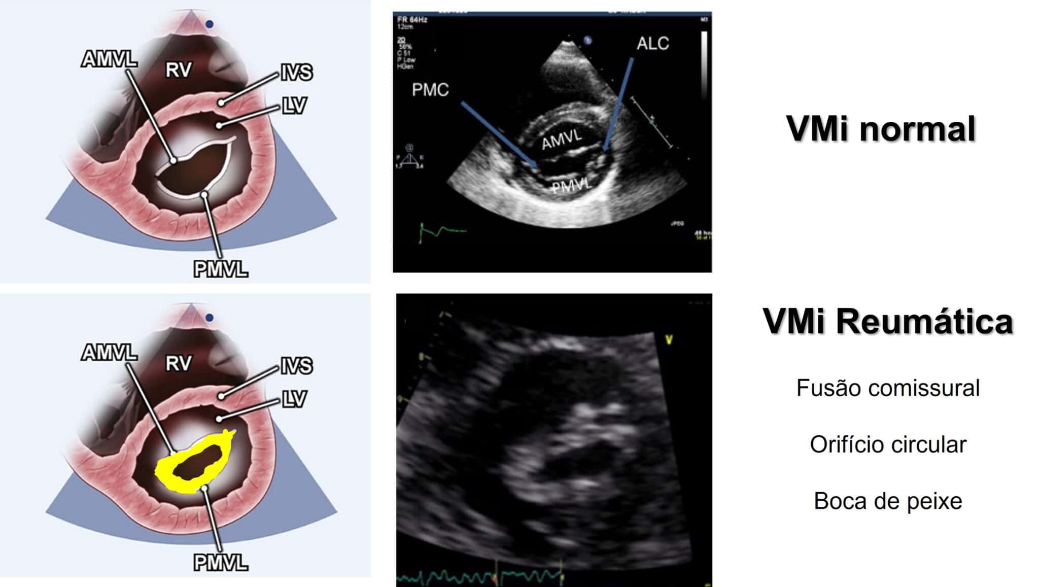 Estenose Mitral Degenerativa x Reumática aspectos ecocardiográficos