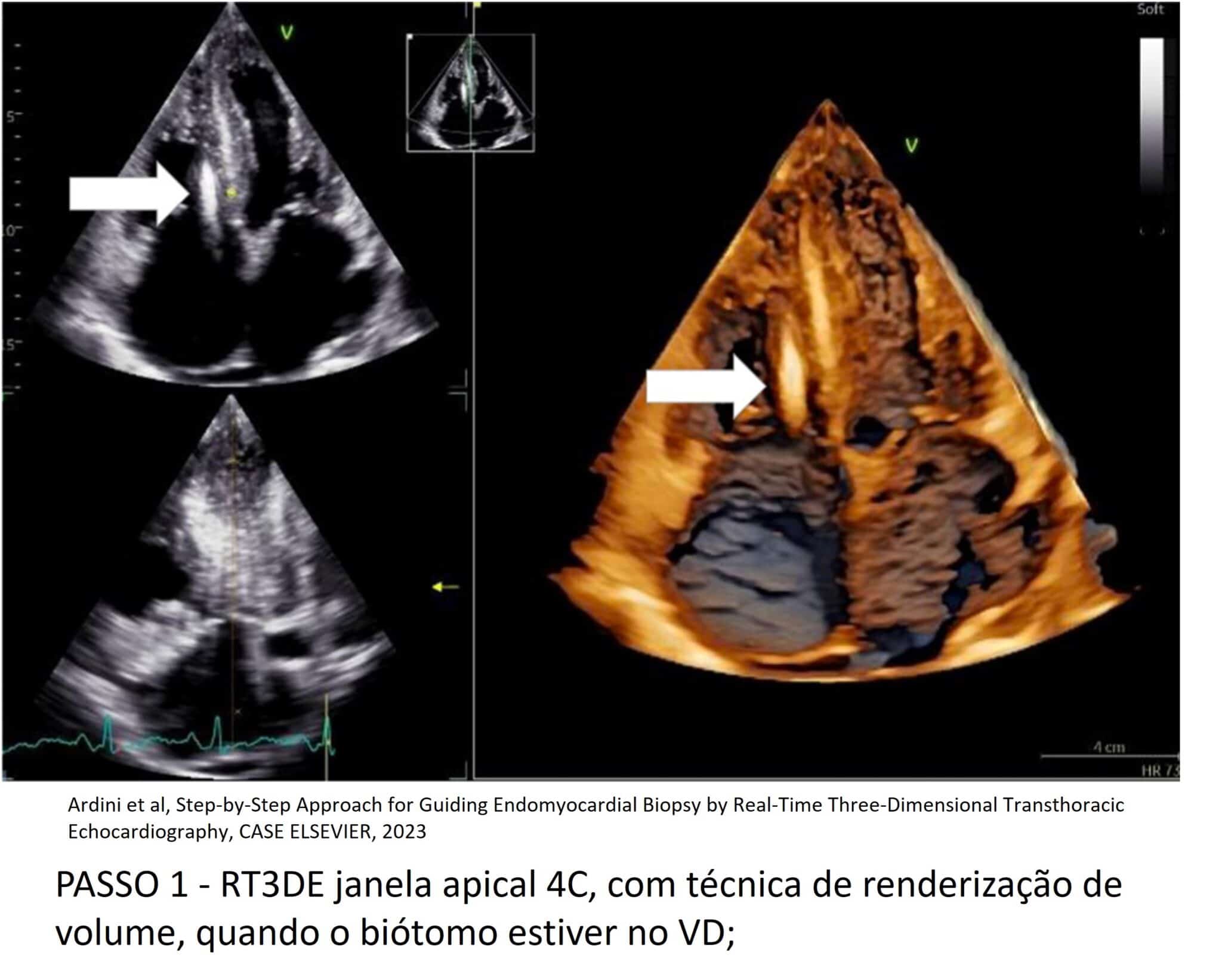 Ecocardiograma Transtorácico 3D na Biópsia Endocárdica ganho em