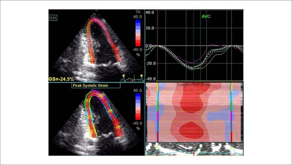 strain-cardiaco-scaled.jpg