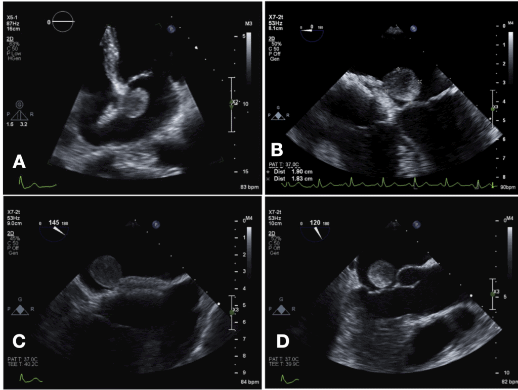 Mixoma-atrial