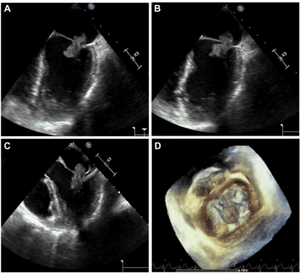 Aspergiloma