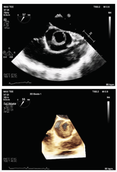 Valva-Aortica-Unicuspide-e-Quadricuspide