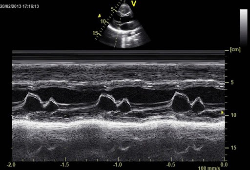 MEDIDAS ECOCARDIOGRÁFICAS EM OBESOS