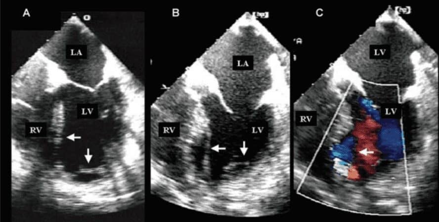 Hematoma-Dissecante-Intramiocardico.jpg