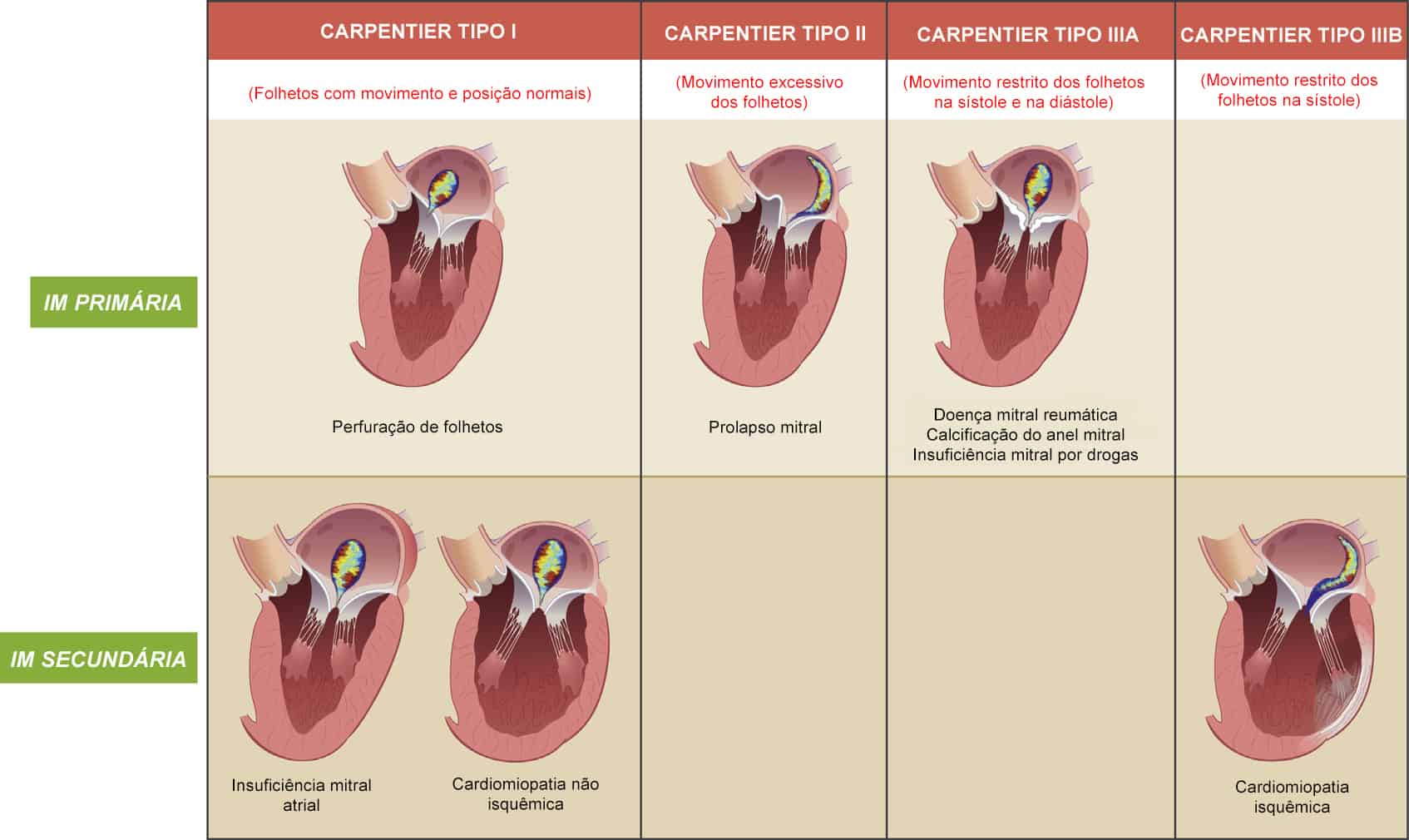 ENTENDENDO A CLASSIFICAÇÃO DE CARPENTIER PARA INSUFICIÊNCIA MITRAL Blog Ecope