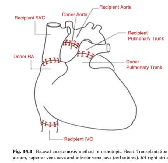 Ecocardiograma-pos-transplante-cardiaco-1-1.jpg