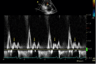 Onda-L-mitral-.png