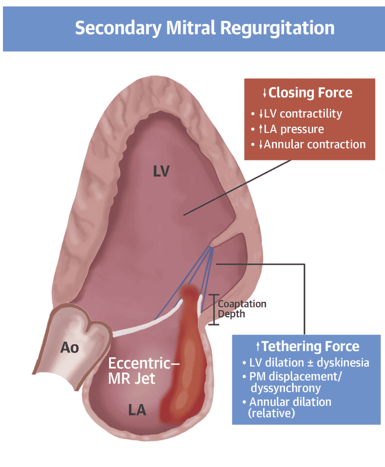 Insuficiencia-Mitral.png