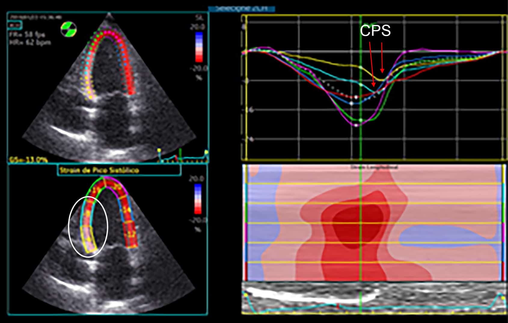 ECOCARDIOGRAFIA DE ESTRESSE PARTE 3 Blog Ecope