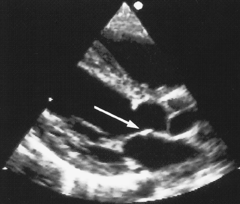 Estenose Aórtica Subvalvar aspectos ecocardiográficos Blog Ecope