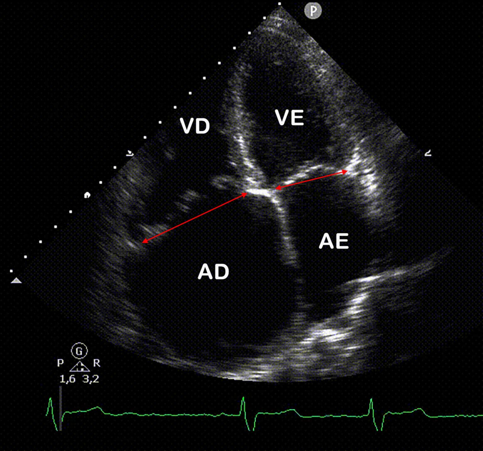 IdentificaÇÃo EcocardiogrÁfica Da HipertensÃo Pulmonar Blog Ecope 2235