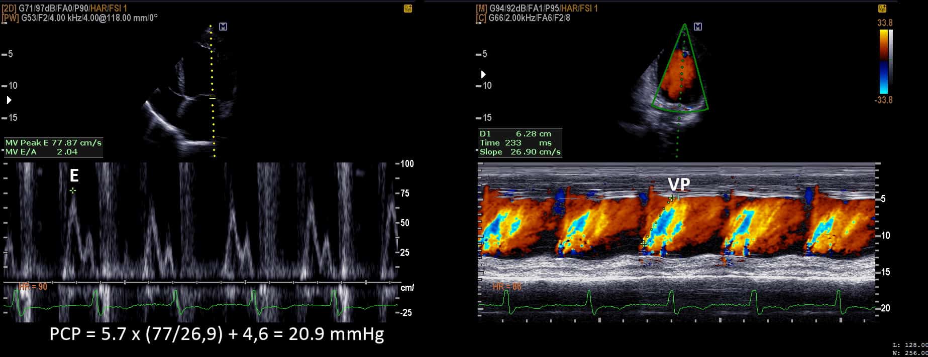 CÁlculo Da PressÃo Capilar Pulmonar Pela Ecocardiografia Blog Ecope 8767