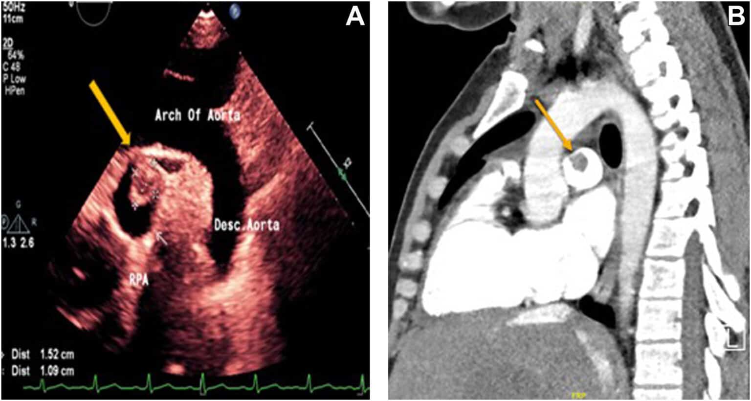 Tromboembolismo Pulmonar E Ecocardiografia Atenção Para A Janela Supraesternal Blog Ecope 0526