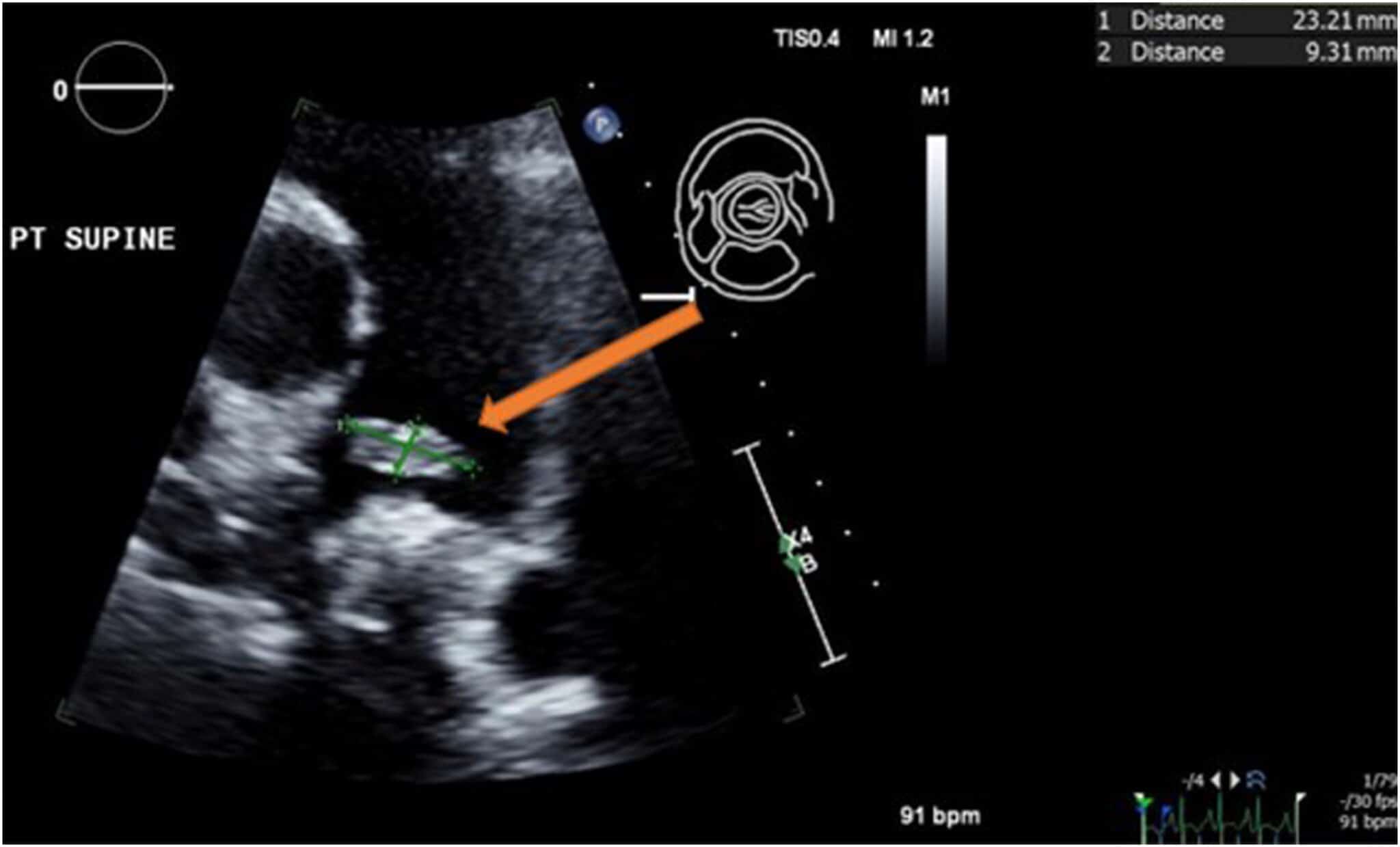 Tromboembolismo Pulmonar E Ecocardiografia Aten O Para A Janela