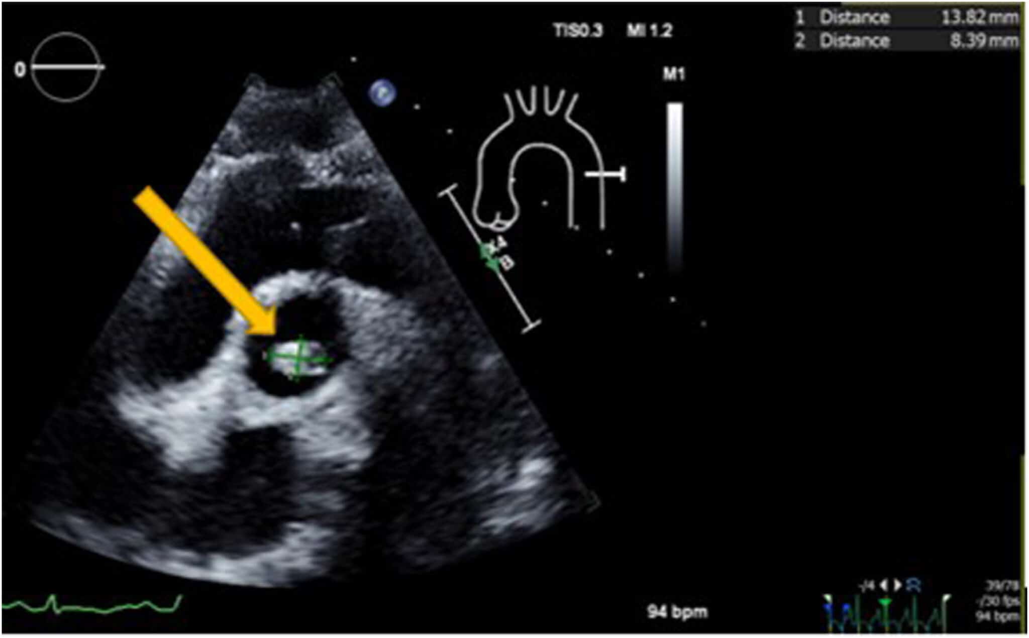 Tromboembolismo Pulmonar e Ecocardiografia atenção para a janela
