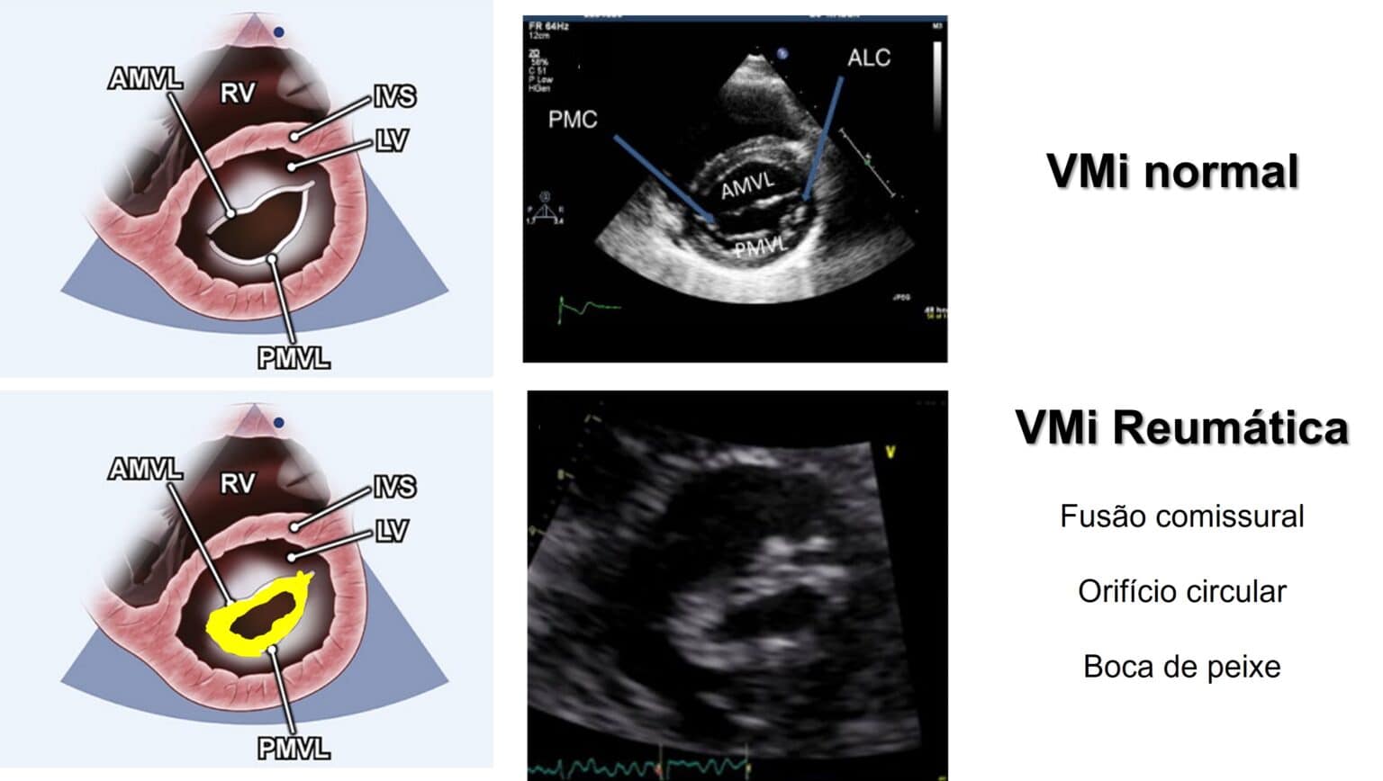 Estenose Mitral Degenerativa X Reumática Aspectos Ecocardiográficos Blog Ecope 3709