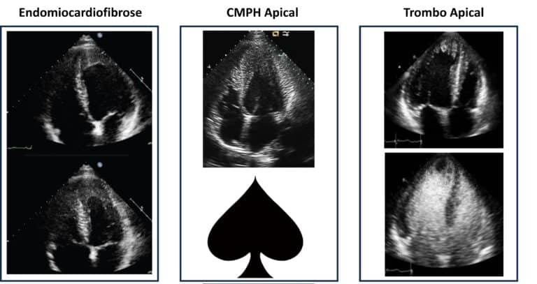 Obliteração Apical: endomiocardiofibrose x cardiomiopatia hipertrófica ...